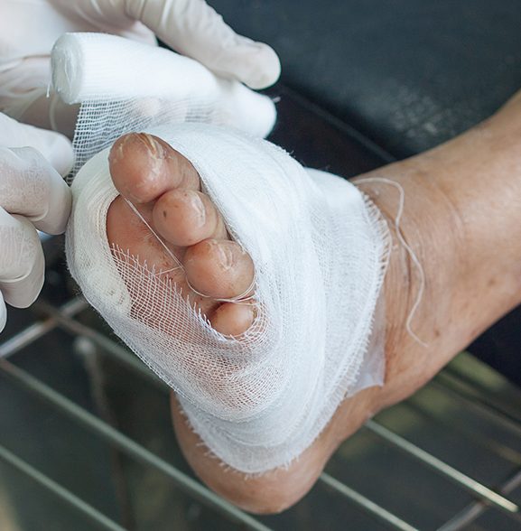 Wrapped up foot with diabetic ulcers