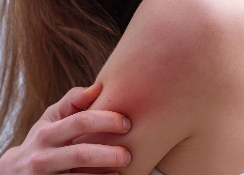 Woman with psoriasis on her arm