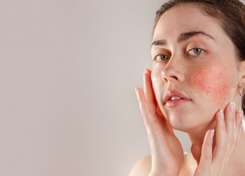 Woman with rosacea on her cheeks