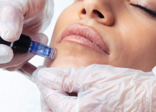 Microneedling: A Skin Revival Procedure