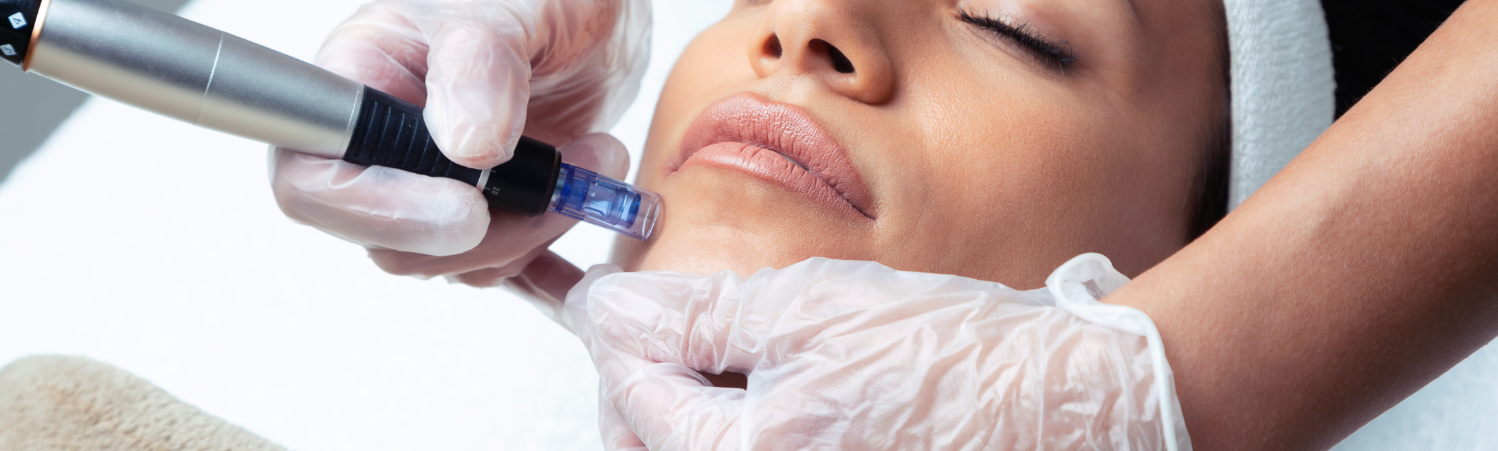 Microneedling: A Skin Revival Procedure